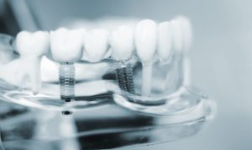 Featured image for “Advantages Of Dental Implants”