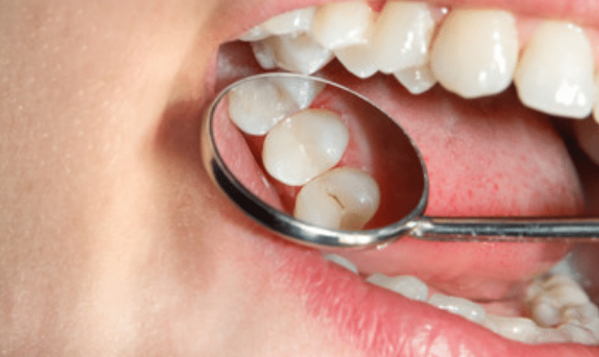 Featured image for “Should You Remove Your Mercury-Silver Dental Fillings?”