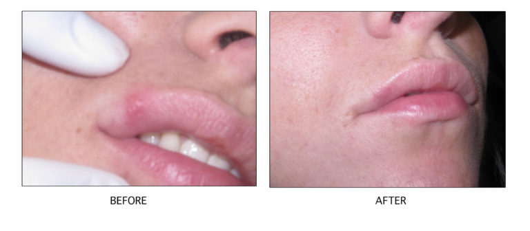 Cold Sore Laser Treatment