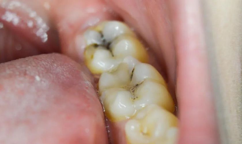  Cavitie treatment