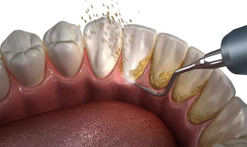 Featured image for “7 Tips to Improve Your Periodontal Maintenance Using The Dentist’s Spotlight”