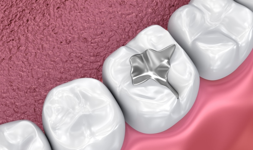 Seal the Deal on Preventive Dentistry: Understanding Dental Sealants