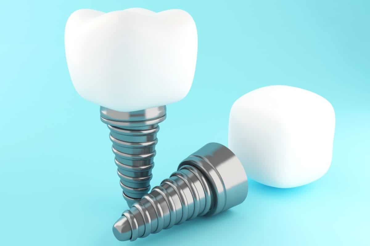 Molar Teeth Implants