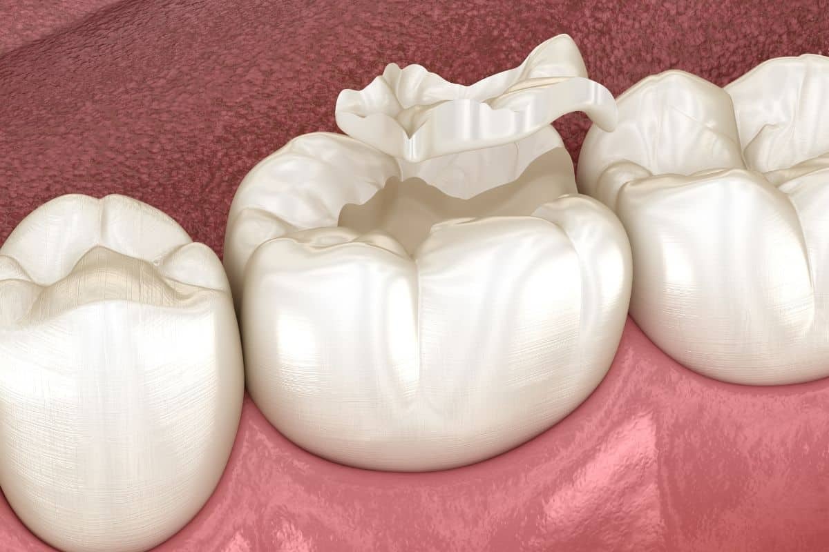 Dental Sealants On Molars