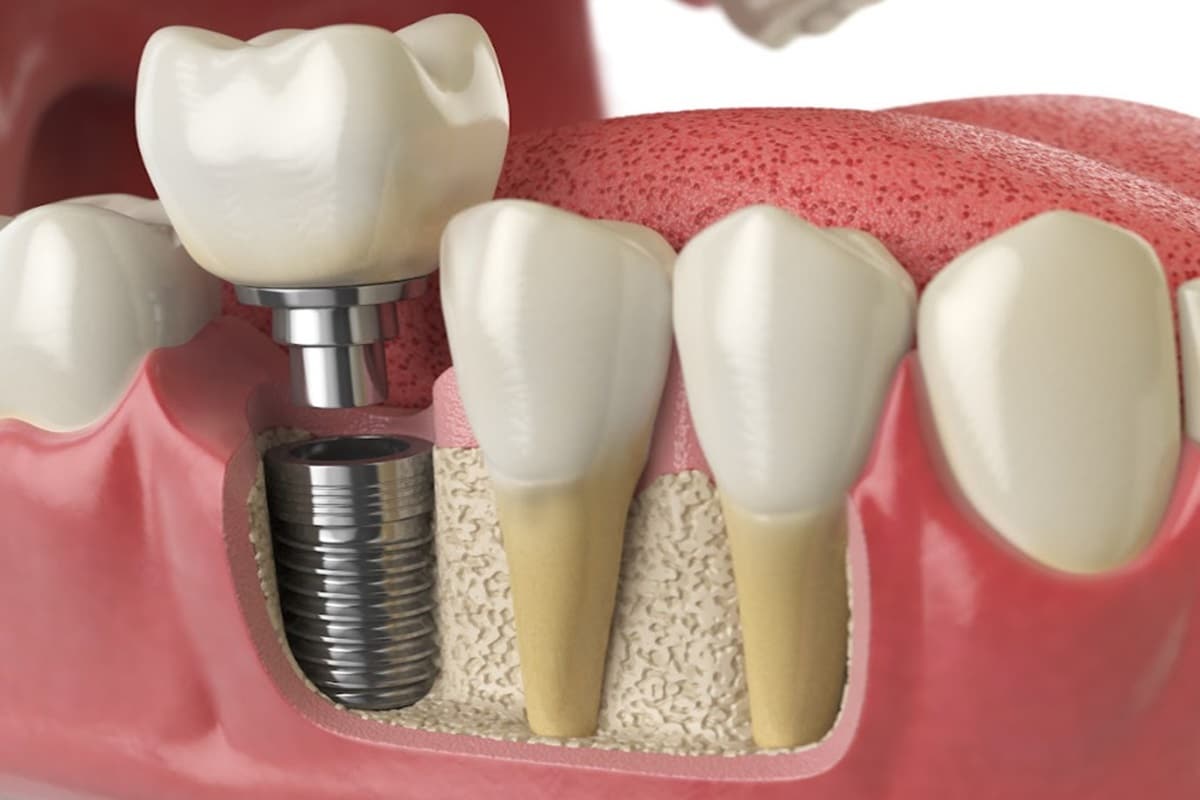 Is A Loose Dental Implant An Emergency