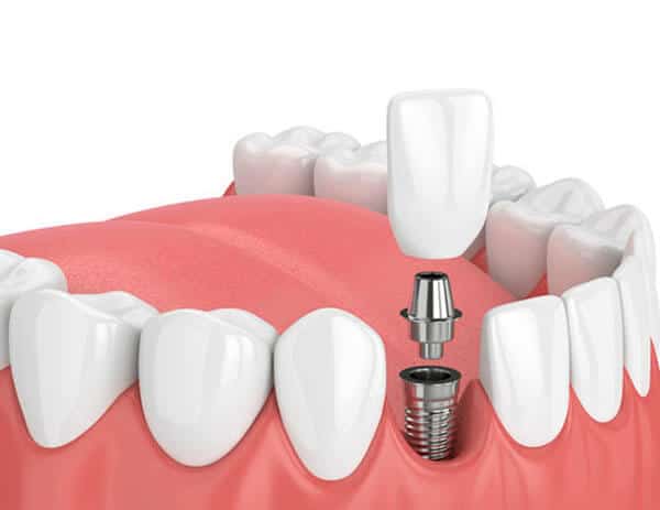 Featured image for “Do I Need to Get My Implant Checked Regularly?”