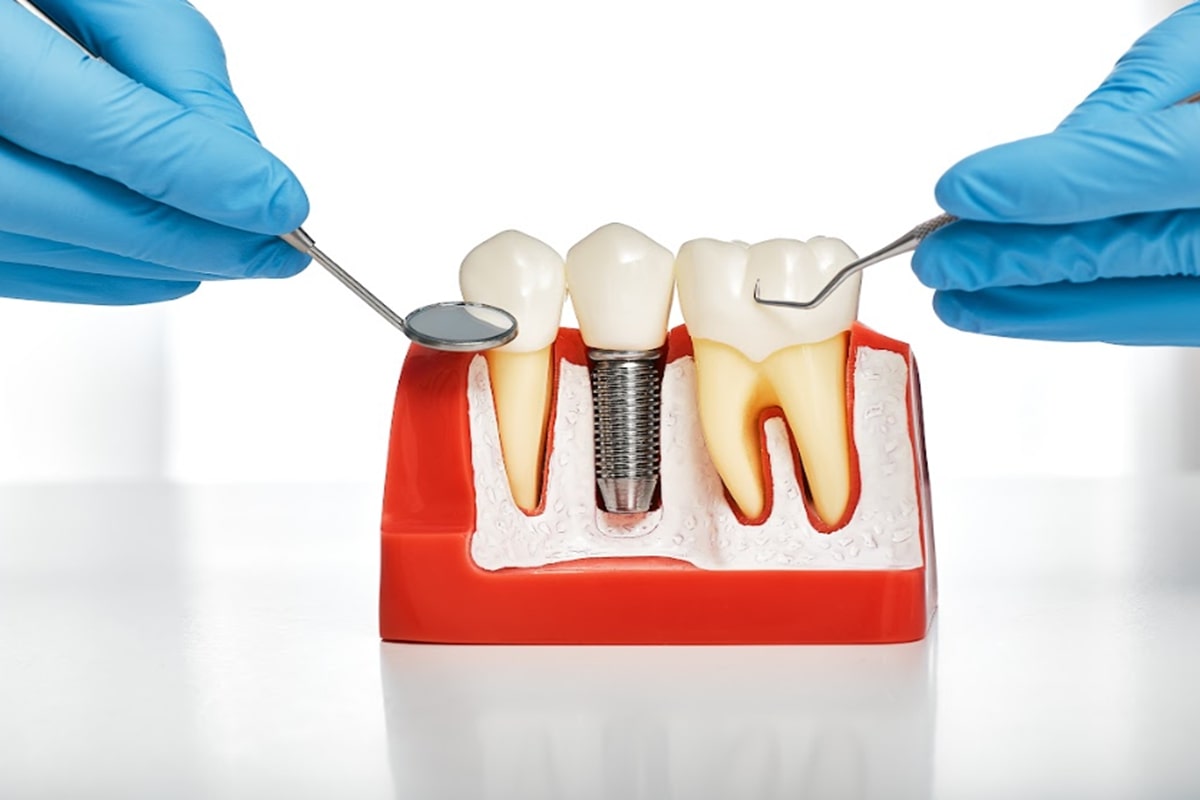 Choosing Dental Implants Over Dentures