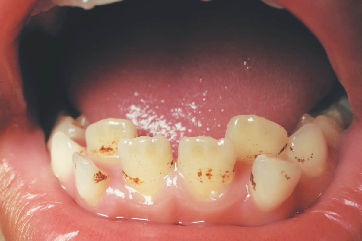 Featured image for “How To Get Rid Of Brown Spots On Teeth”