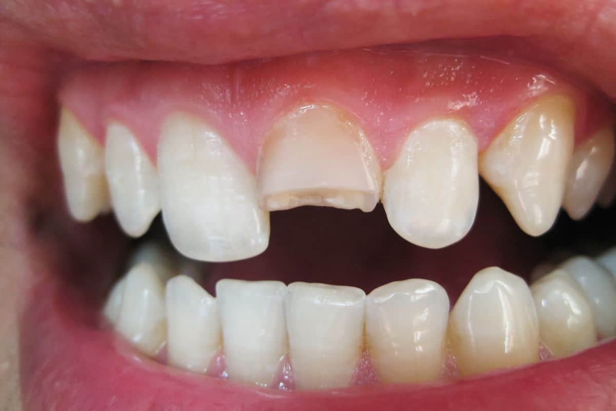 Can a Cosmetic Dentist Fix a Chipped Tooth in One Visit