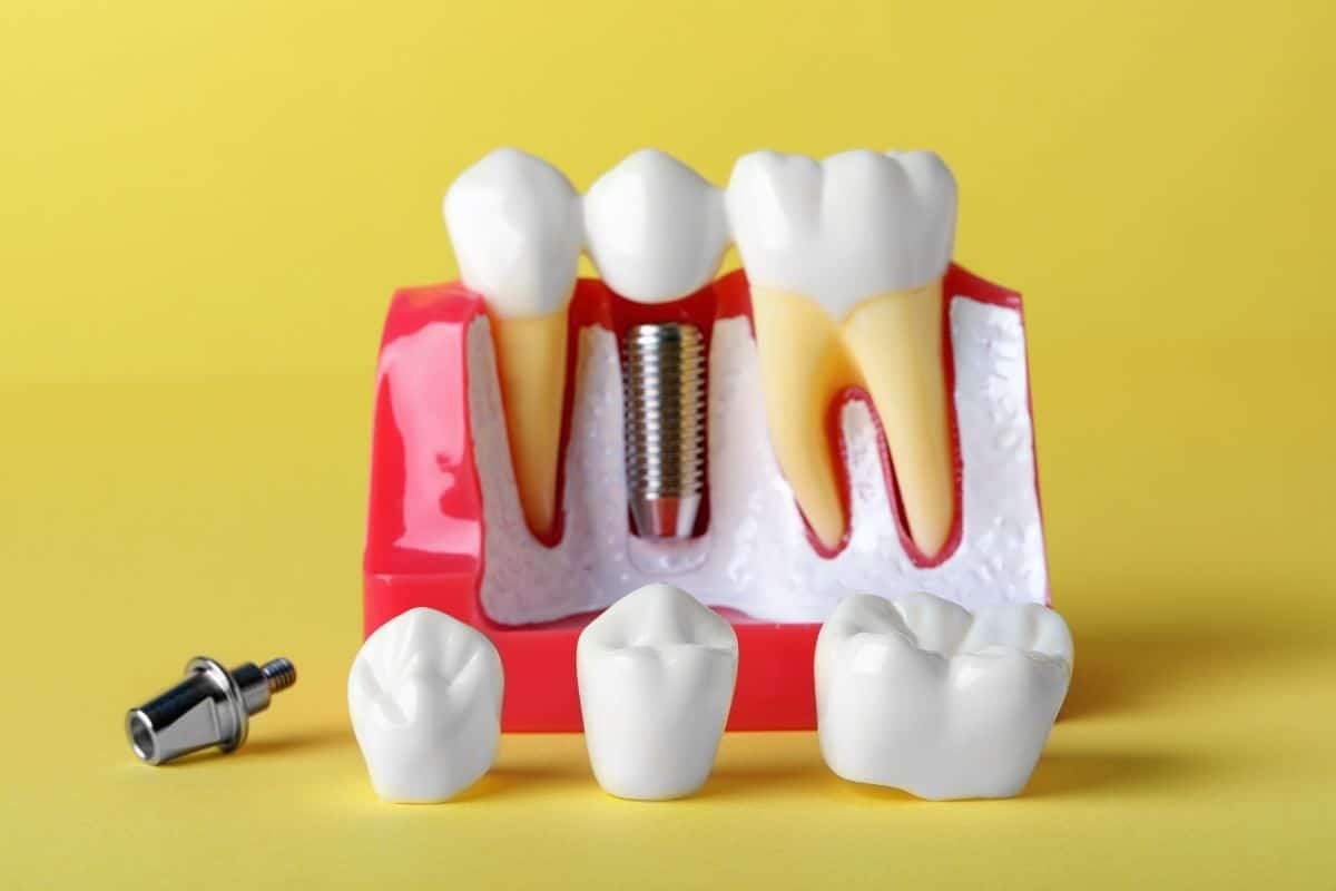 Is a Bone Graft Necessary for Dental Implant