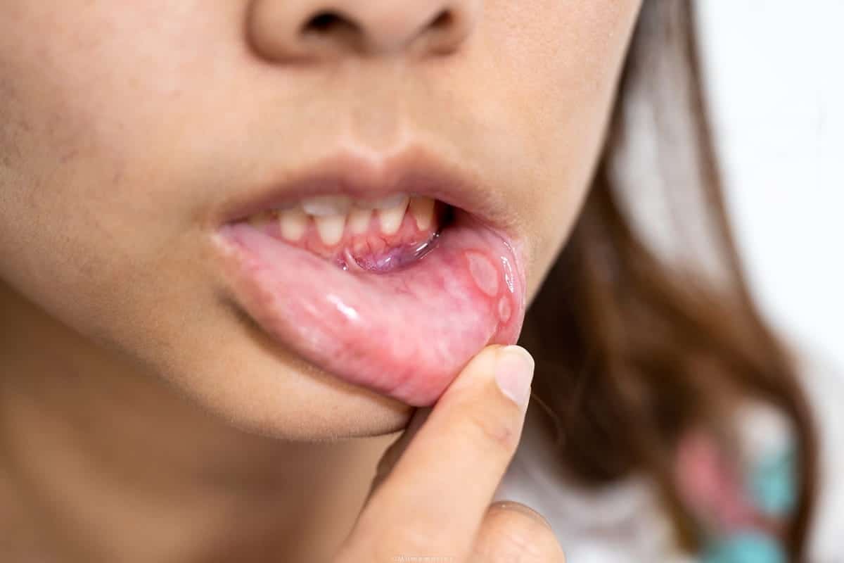 Cold Sores on Lips