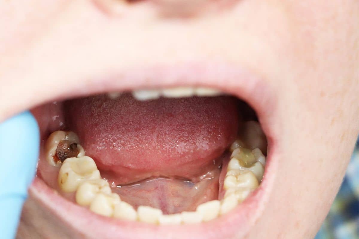 How To Heal Cavities In 2 Days At Home