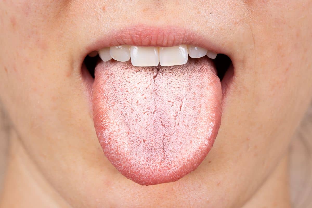 Featured image for “Why Is My Tongue White? Causes, Symptoms, and Treatments”
